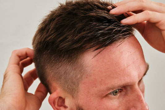 recceding hairline
