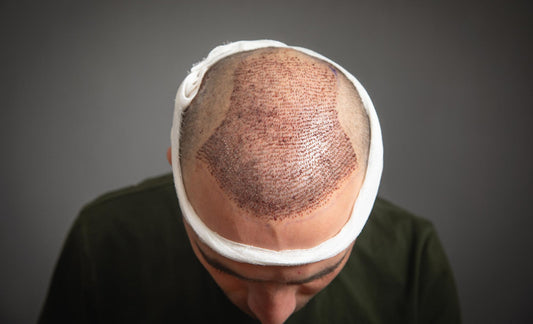 hair transplant
