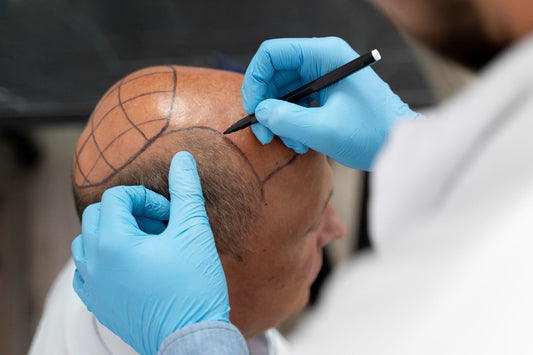 When Is the Best Time for a Hair Transplant in Las Vegas?