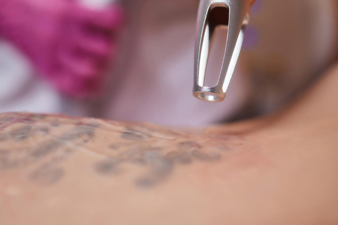 tattoo removal