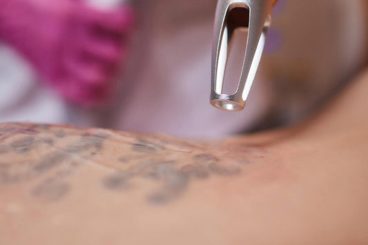 tattoo removal