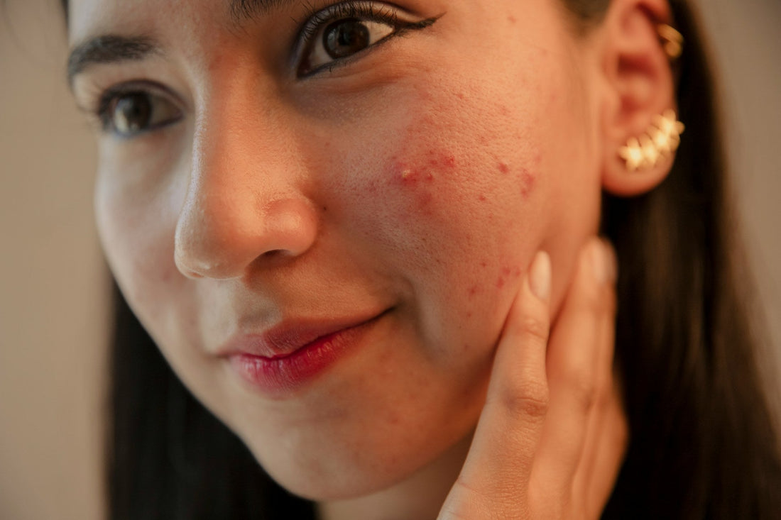 Spring acne breakout