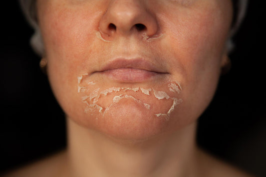 skin peeling after facial