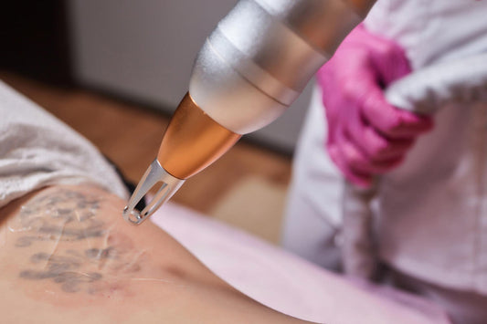 tattoo removal