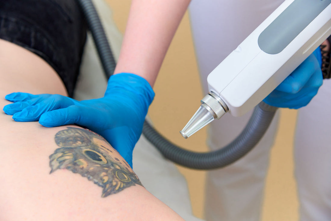 tattoo removal
