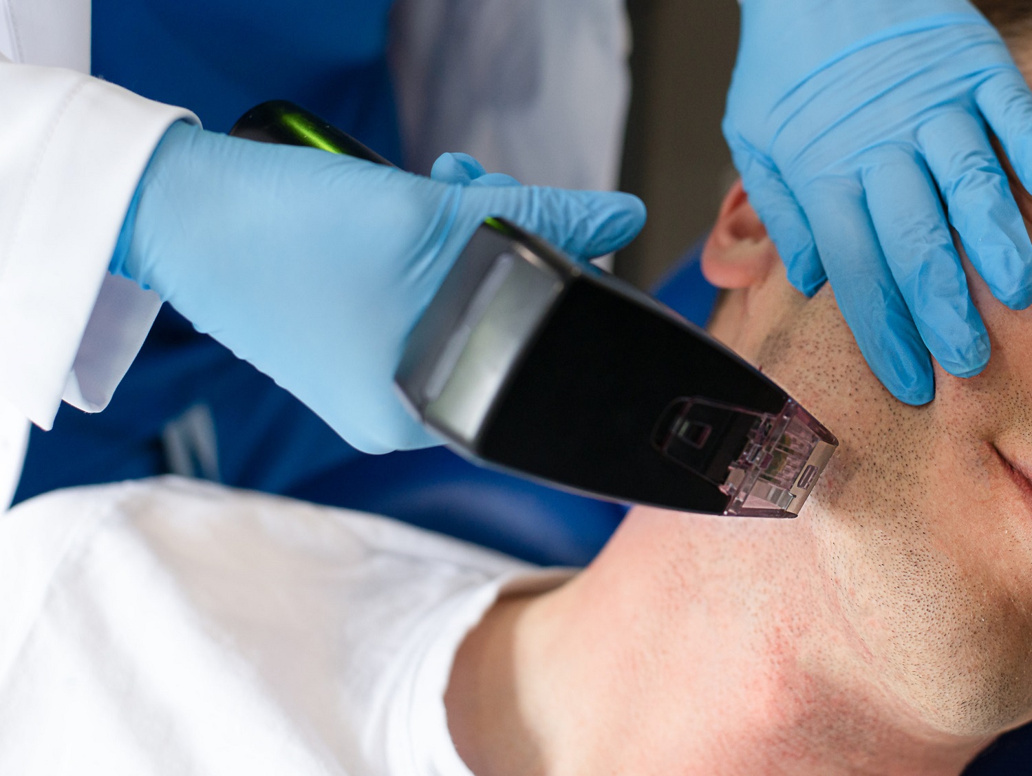 Handsome Man Receiving Microneedling Treatment | Abrams Aesthetics and Hair Restoration in Henderson, NV