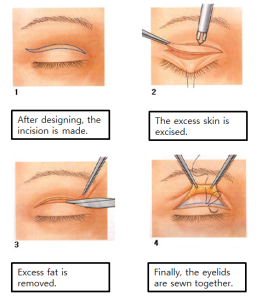 Eyelid Surgery Blepharoplasty